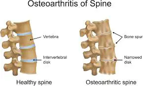 Spondylosis spondylosis ayurvedic treatment