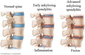 spondylosis ayurvedic treatment