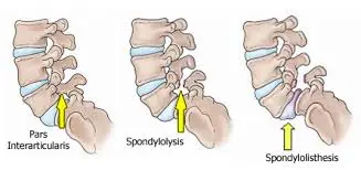 spondylosis ayurvedic treatment