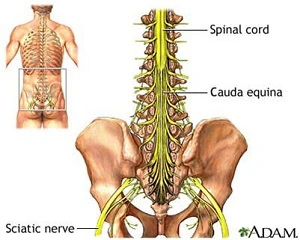 PIVD-Prolapsed Inter Vertebral Disc-IVDP