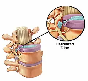 PIVD Prolapsed Inter Vertebral Disc IVDP