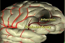 CVA- Cerebro vascular Accident