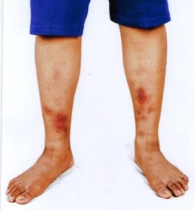 erythema nodosum treatment