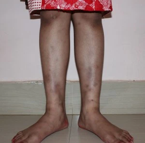 erythema nodosum treatment