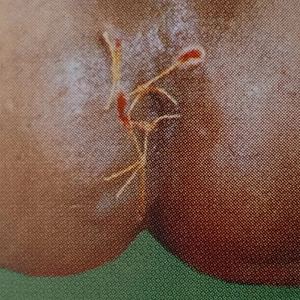 Fistula-in-Ano Ayurvedic Treatment