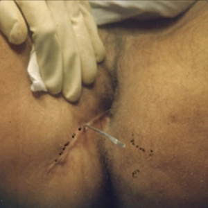 Fistula-in-Ano