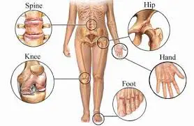 osteoarthritis causes symptoms and treatment