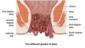 Hemorrhoid's piles