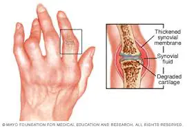 Rheumatoid Arthritis Ayurveda treatment