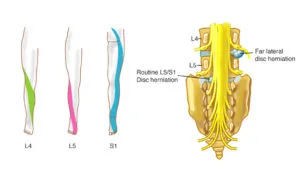 Sciatica symptoms