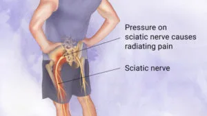 Sciatica symptoms