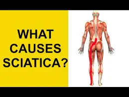 Sciatica Causes
