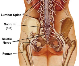 sciatica herbal treatment