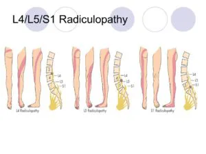 Sciatica symptoms