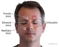 Sinusitis