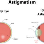 Astigmatism ayurveda eye cure