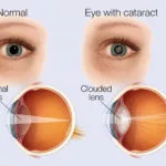 Cataract Eye ayurvedic Treatment