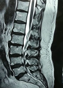Back pain Treatment