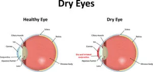 dry eye treatment
