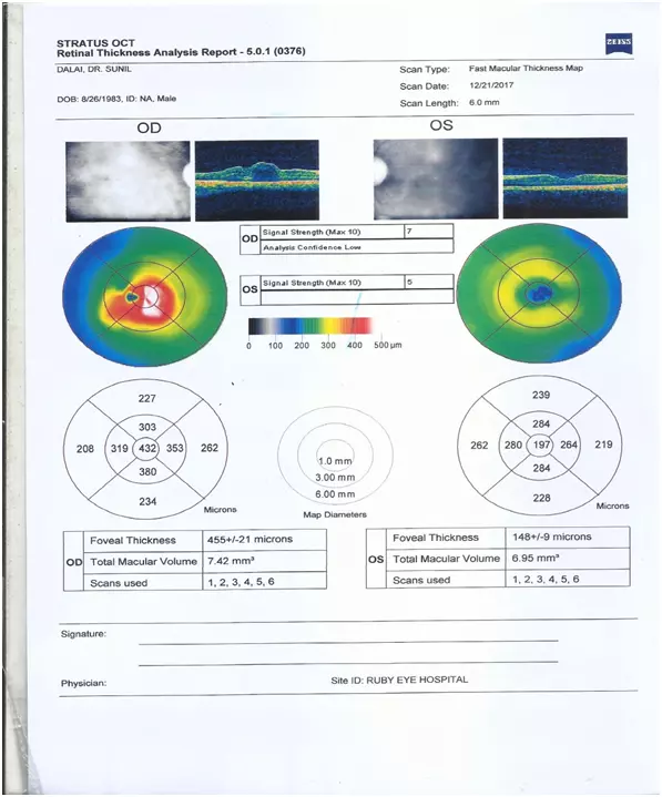 csr eye ayurvedic treatment