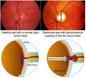 ayurvedic treatment for glaucoma