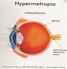 hypermetropia