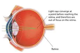 Myopia Ayurvedic Treatment