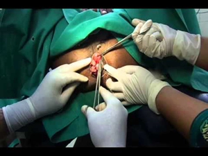 piles treatment in bhubaneswar