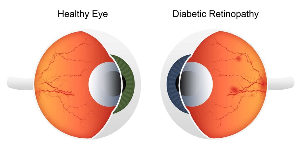 diabetic retinopathy