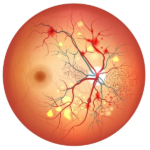 diabetic retinopathy