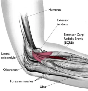 Tennis Elbow